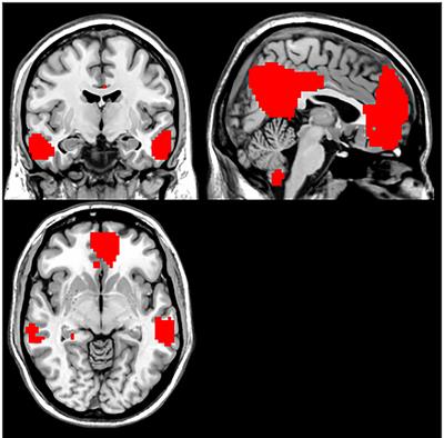 Abnormal Default-Mode Network Homogeneity in Patients With Mild Cognitive Impairment in Chinese Communities